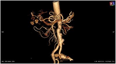 Simultaneous Laparoscopic Cholecystectomy and Endovascular Infrarenal Aortic Aneurysm Repair